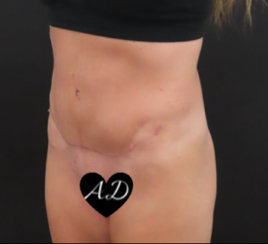 Abdominoplasty